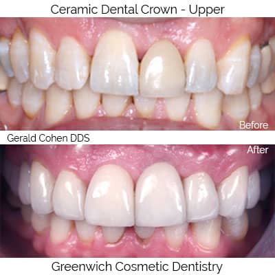 All Ceramic Crowns  | Greenwich CT Dentist | Greenwich Cosmetic Dentistry