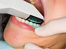 digital dental impressions scanner