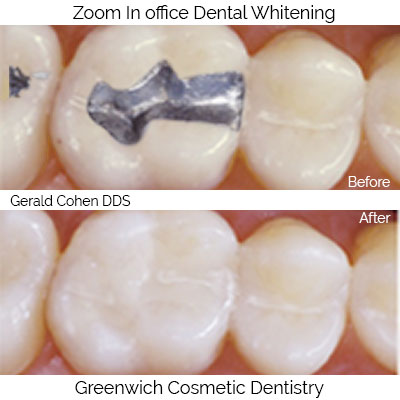 Tooth colored restorations before and after