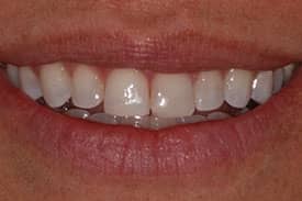 Invisalign Invisible Braces - After | Greenwich CT Dentist | Greenwich Cosmetic Dentistry