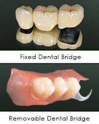 Dental Bridge  | Greenwich CT Dentist | Greenwich Cosmetic Dentistry