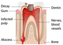 Dental root canal | Greenwich CT Dentist | Greenwich Cosmetic Dentistry