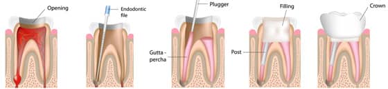 Root Canal Illustrated Process | Greenwich CT Dentist | Greenwich Cosmetic Dentistry