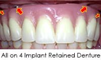 All-on-4 ®, Teeth in a Day, Teeth in an Hour | Greenwich CT Dentist | Greenwich Cosmetic Dentistry