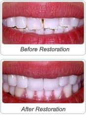 before after image of dental bonding and veenering