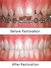 Prosthodontic restoration image