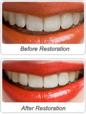 Cosmetic Dental Recountouring  | Greenwich CT Dentist | Greenwich Cosmetic Dentistry