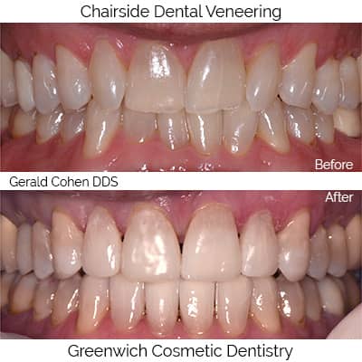 Chairside dental veneer | Greenwich CT Dentist | Greenwich Cosmetic Dentistry