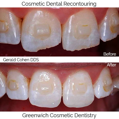 Cosmetic Dental Recountouring | Greenwich CT Dentist | Greenwich Cosmetic Dentistry