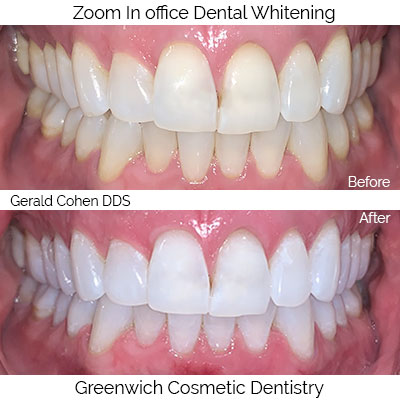 Laser Whitening - before - after