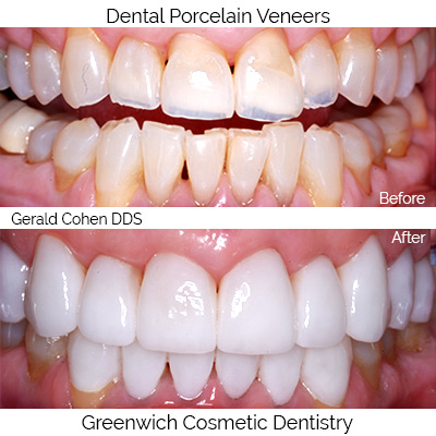 Dental Porcelain  Veneers restoration | Greenwich CT Dentist | Greenwich Cosmetic Dentistry