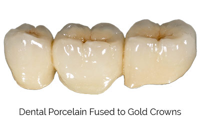 Dental Porcelain Fused to Gold Crowns | Greenwich CT Dentist | Greenwich Cosmetic Dentistry