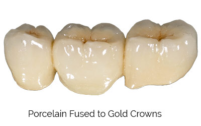 Dental Porcelain Fused to Gold Crowns