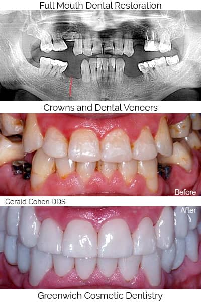 Full mouth restoration | Greenwich CT Dentist | Greenwich Cosmetic Dentistry