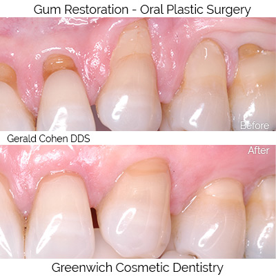 Oral Plastic Surgery of Gums | Greenwich CT Dentist | Greenwich Cosmetic Dentistry