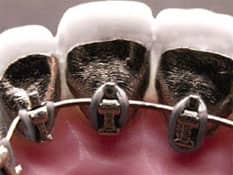 Orthodontic sub lingual braces  | Greenwich CT Dentist | Greenwich Cosmetic Dentistry