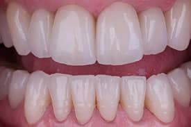 All-Ceramic Crowns - After | Greenwich CT Dentist | Greenwich Cosmetic Dentistry