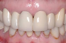 All-Ceramic Crowns - Before | Greenwich CT Dentist | Greenwich Cosmetic Dentistry