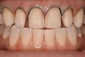 Invisalign & Veneers - Before | Greenwich CT Dentist | Greenwich Cosmetic Dentistry