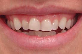 Invisalign Invisible Braces - Before | Greenwich CT Dentist | Greenwich Cosmetic Dentistry