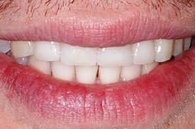 Invisalign & Veneers - After | Greenwich CT Dentist | Greenwich Cosmetic Dentistry
