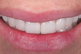 Invisalign & Veneers - After | Greenwich CT Dentist | Greenwich Cosmetic Dentistry