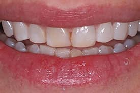 Invisalign & Veneers - Before | Greenwich CT Dentist | Greenwich Cosmetic Dentistry