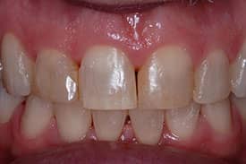 Invisalign & Veneers - Before | Greenwich CT Dentist | Greenwich Cosmetic Dentistry