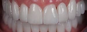 Veneers and Ceramic Crowns - After