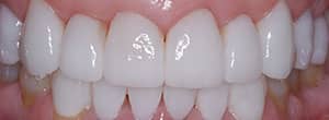 Veneers and Ceramic Crowns - After