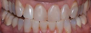 Veneers and Ceramic Crowns - Before