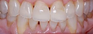 Veneers and Ceramic Crowns - Before