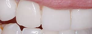 Peg lateral (small teeth) incisor correction with dental veneer - After