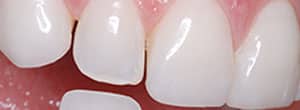 Peg lateral (small teeth) incisor correction with dental veneer - Before
