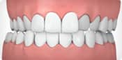 Invisalign correctable - cross bite | Greenwich CT Dentist | Greenwich Cosmetic Dentistry
