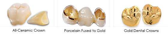 Dental Crown Restoration Types | Greenwich CT Dentist | Greenwich Cosmetic Dentistry