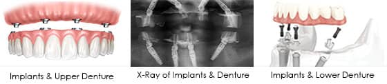Greenwich dentist implant retained denture