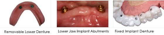 Implant retained denture | Greenwich CT Dentist | Greenwich Cosmetic Dentistry