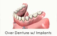 Upper Denture in Greenwich CT