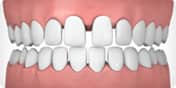 Invisalign correctable - spacing | Greenwich CT Dentist | Greenwich Cosmetic Dentistry