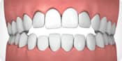 Invisalign correctable - open bite | Greenwich CT Dentist | Greenwich Cosmetic Dentistry