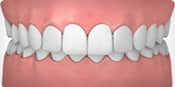 Invisalign correctable - overbite | Greenwich CT Dentist | Greenwich Cosmetic Dentistry