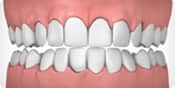 Invisalign correctable - overcrowing | Greenwich CT Dentist | Greenwich Cosmetic Dentistry