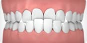 Invisalign correctable - underbite | Greenwich CT Dentist | Greenwich Cosmetic Dentistry