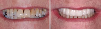 Smile Makeover Dental Work - Maureen  | Greenwich CT Dentist | Greenwich Cosmetic Dentistry