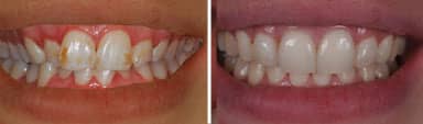 Smile Makeover Dental Work - Shiloh | Greenwich CT Dentist | Greenwich Cosmetic Dentistry
