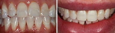 Smile Makeover Dental Work - Tasha  | Greenwich CT Dentist | Greenwich Cosmetic Dentistry